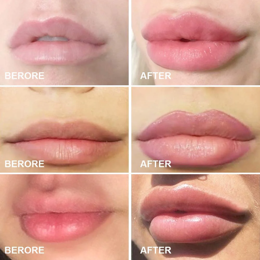 Lips Enhancer Device - Image 5